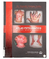 A Photographic Atlas Of Burn Injuries Our Story Books Queen Catalina