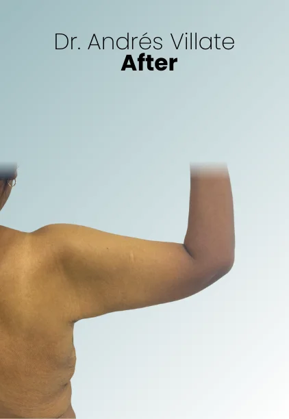 Arm Lift Procedure Img1 Queen Catalina