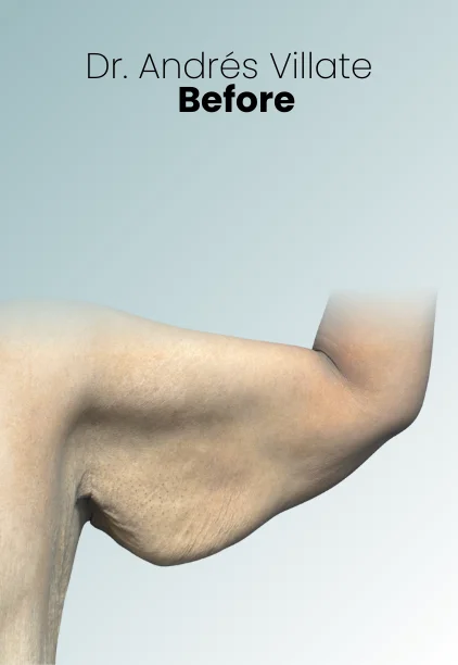 Arm Lift Procedure Img2 Queen Catalina