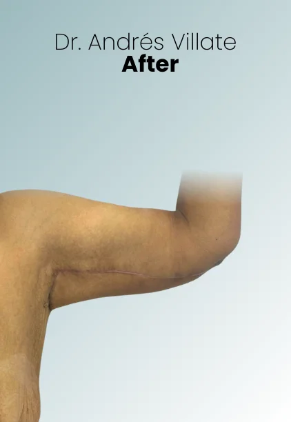 Arm Lift Procedure Img3 Queen Catalina