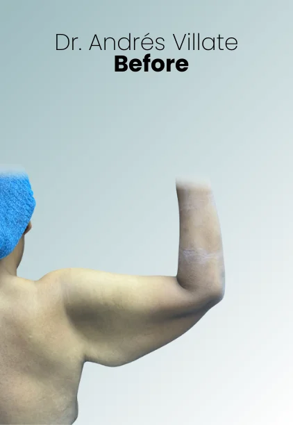 Arm Lift Procedure Img4 Queen Catalina