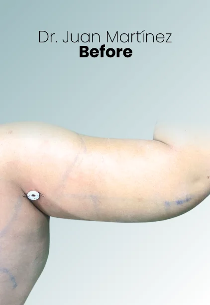 Arm Lift Procedure Img5 Queen Catalina