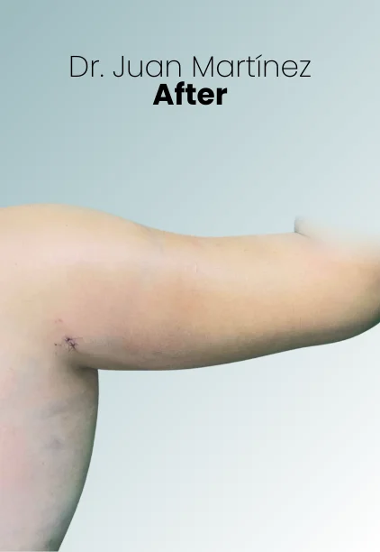 Arm Lift Procedure Img6 Queen Catalina