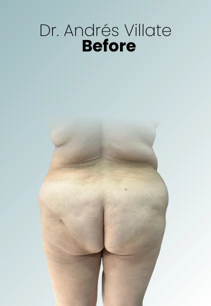 Bbl Procedure Img11 Queen Catalina