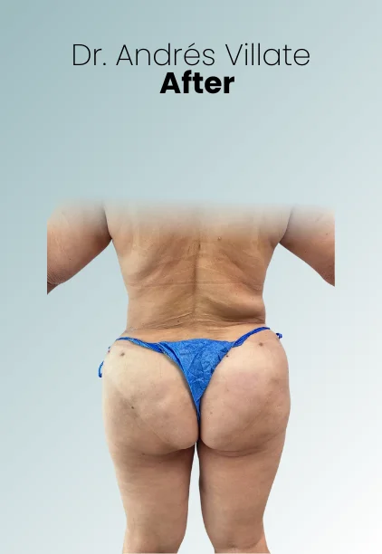 Bbl Procedure Img12 Queen Catalina