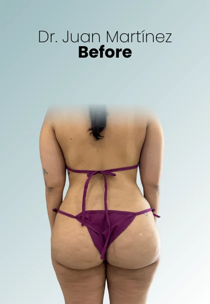 Bbl Procedure Img14 Queen Catalina