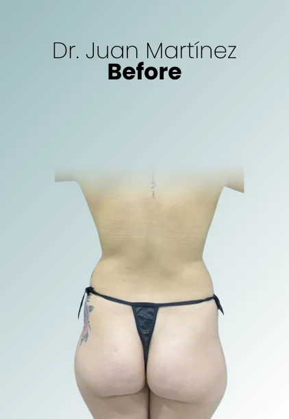 Bbl Procedure Img15 Queen Catalina