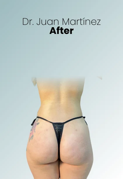 Bbl Procedure Img16 Queen Catalina