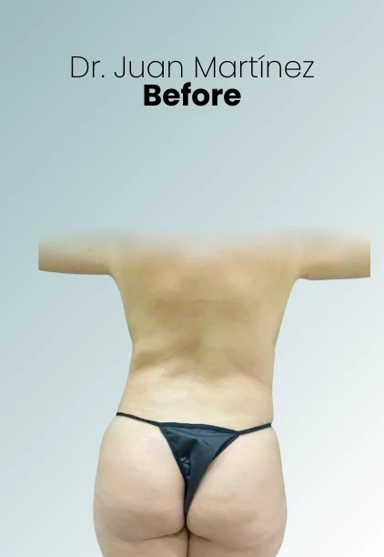 Bbl Procedure Img17 Queen Catalina