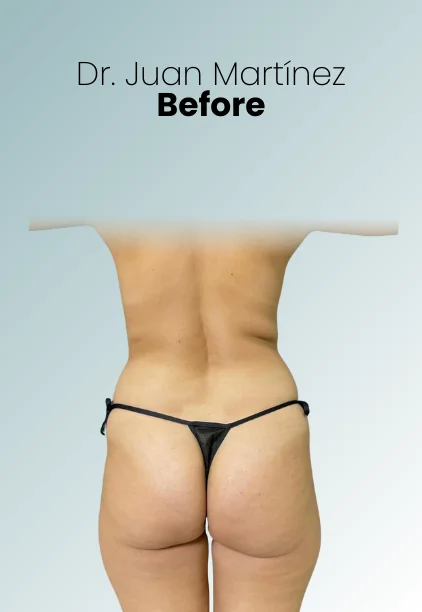 Bbl Procedure Img18 Queen Catalina