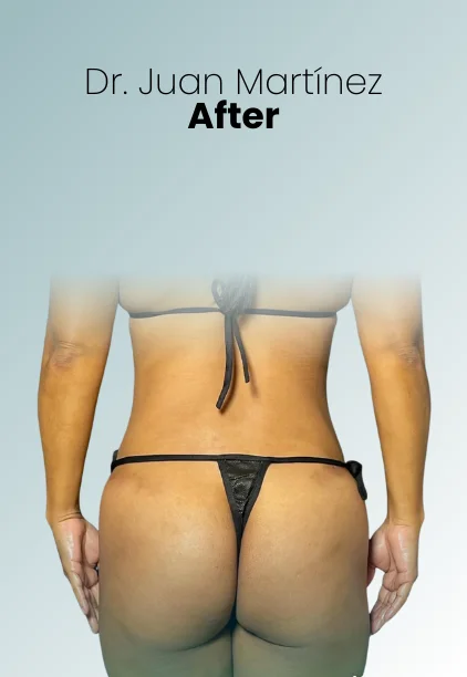 Bbl Procedure Img21 Queen Catalina