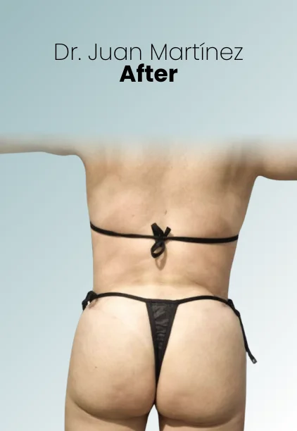 Bbl Procedure Img4 Queen Catalina