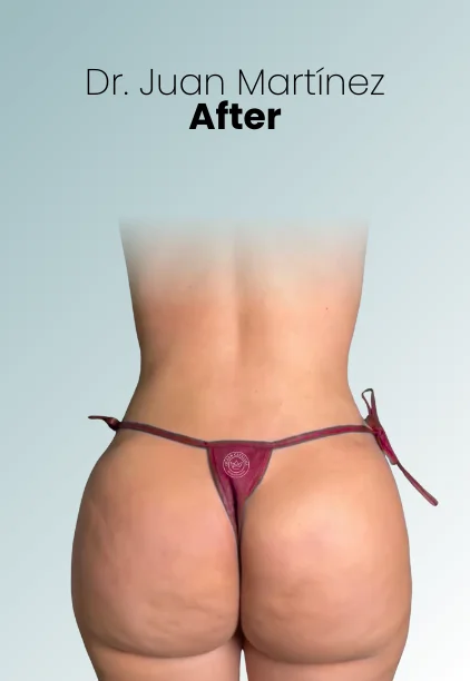 Bbl Procedure Img5 Queen Catalina