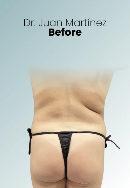 Bbl Procedure Img6 Queen Catalina