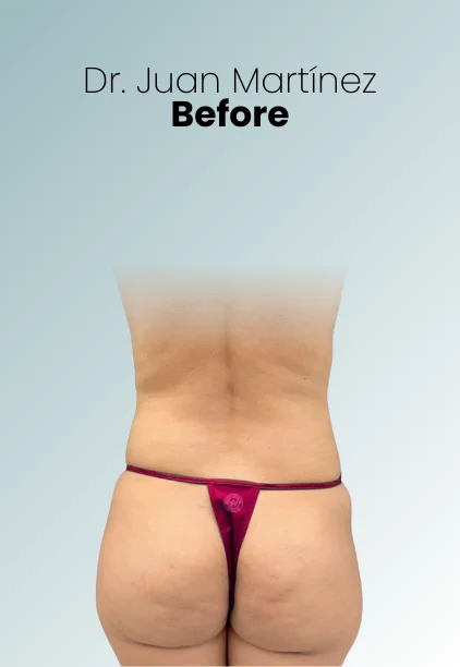 Bbl Procedure Img8 Queen Catalina