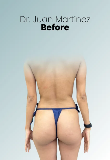 Bbl Procedure Img9 Queen Catalina