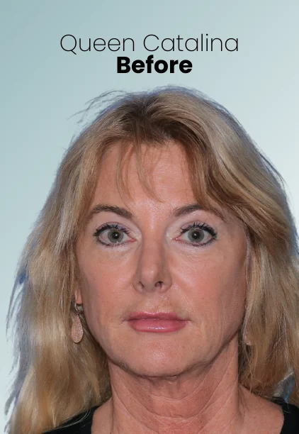 Blepharoplasty Procedure Img10 Queen Catalina