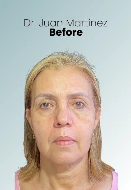 Blepharoplasty Procedure Img11 Queen Catalina