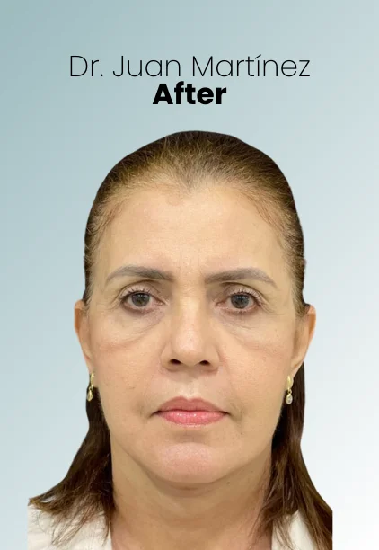 Blepharoplasty Procedure Img12 Queen Catalina