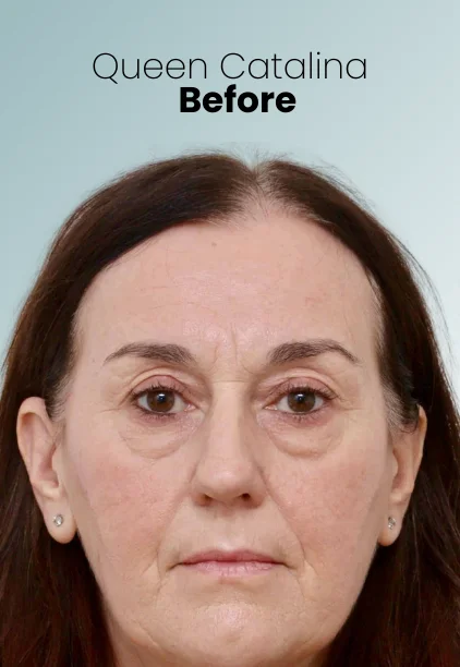 Blepharoplasty Procedure Img6 Queen Catalina