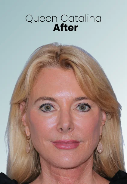 Blepharoplasty Procedure Img7 Queen Catalina