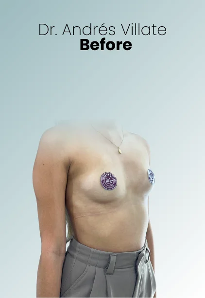 Breast Augmentation Procedure Img2 Queen Catalina