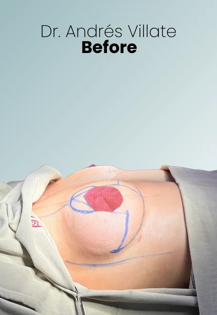 Breast Lift Augmentation Procedure Img10 Queen Catalina