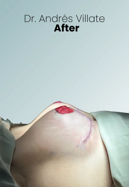 Breast Lift Augmentation Procedure Img6 Queen Catalina