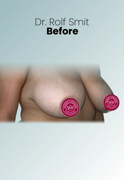 Breast Lift Procedure Img5 Queen Catalina