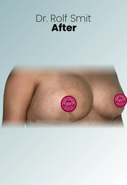 Breast Lift Procedure Img6 Queen Catalina