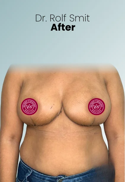 Breast Reduction Procedure Img1 Queen Catalina