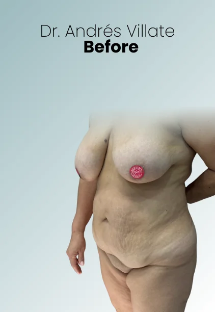 Breast Reduction Procedure Img10 Queen Catalina