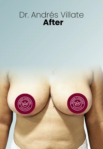 Breast Reduction Procedure Img12 Queen Catalina