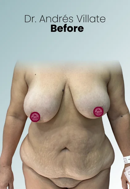 Breast Reduction Procedure Img13 Queen Catalina