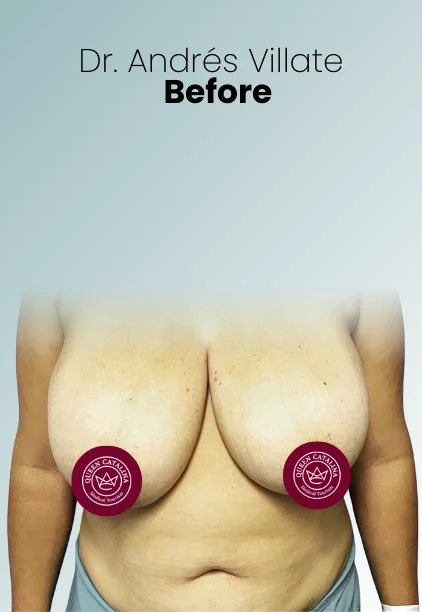 Breast Reduction Procedure Img3 Queen Catalina