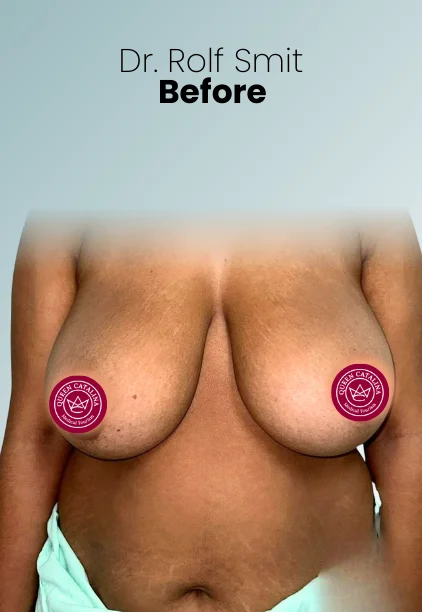 Breast Reduction Procedure Img4 Queen Catalina