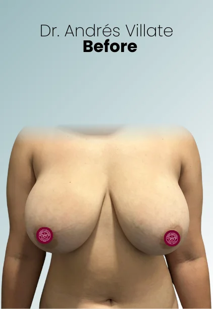 Breast Reduction Procedure Img7 Queen Catalina