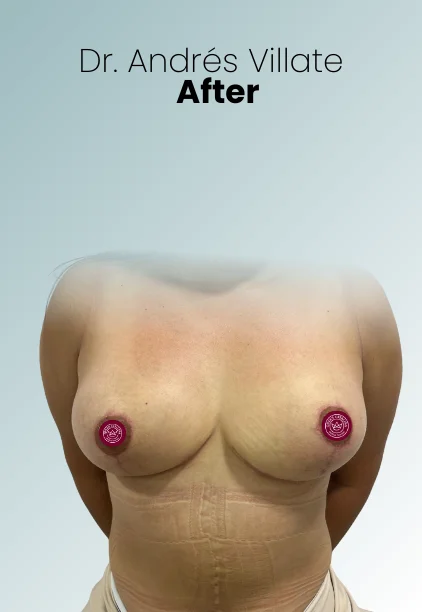 Breast Reduction Procedure Img8 Queen Catalina