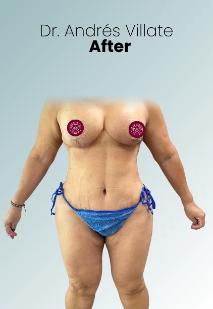 Breast Reduction Procedure Img9 Queen Catalina