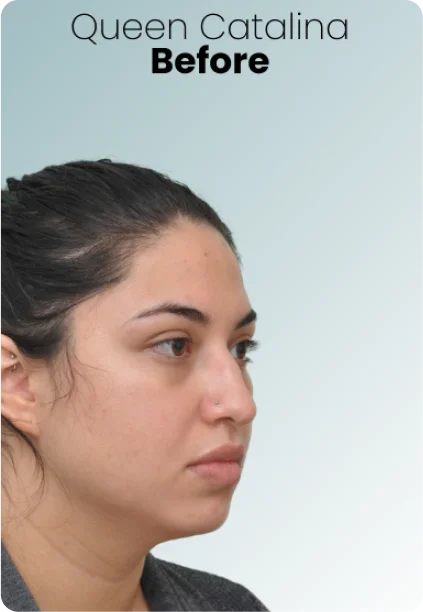 Buccal Fat Removal Procedure Img1 Queen Catalina