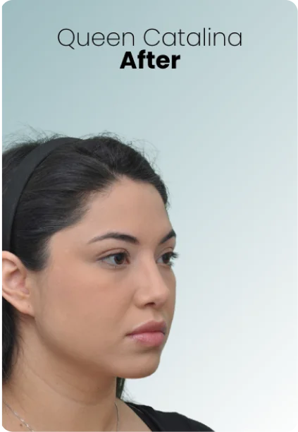 Buccal Fat Removal Procedure Img2 Queen Catalina