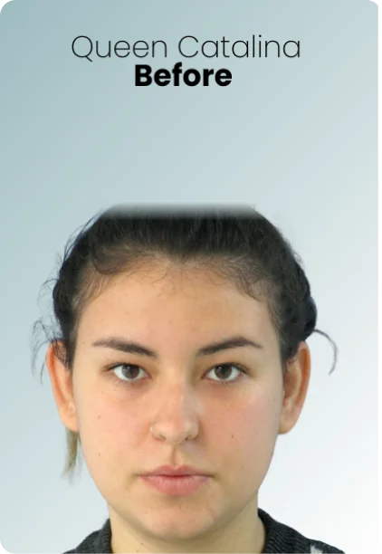 Buccal Fat Removal Procedure Img3 Queen Catalina