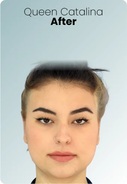 Buccal Fat Removal Procedure Img4 Queen Catalina