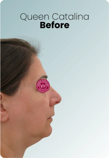 Chin Liposuction Procedure Img1 Queen Catalina