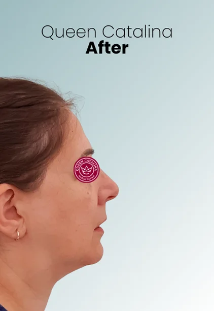 Chin Liposuction Procedure Img2 Queen Catalina