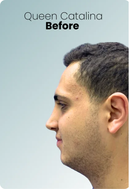 Chin Liposuction Procedure Img3 Queen Catalina