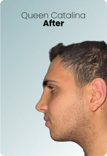 Chin Liposuction Procedure Img4 Queen Catalina