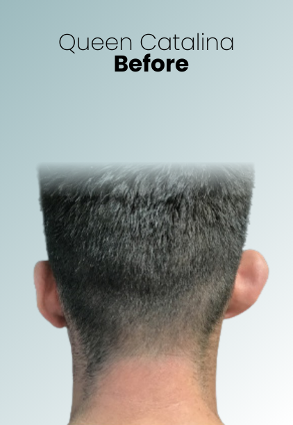 Ear Surgery Procedure Img3 Queen Catalina