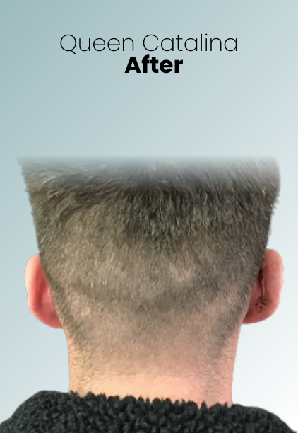 Ear Surgery Procedure Img4 Queen Catalina