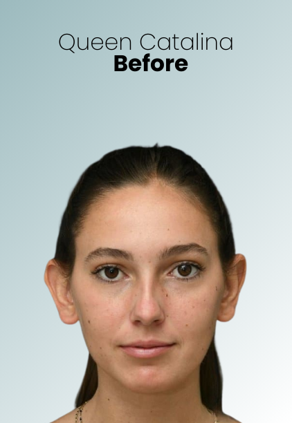 Ear Surgery Procedure Img6 Queen Catalina